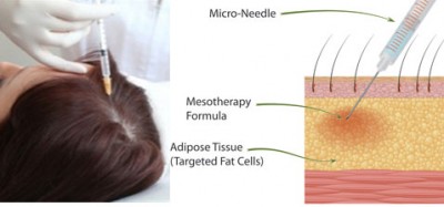 mesotherapy-for-hairloss